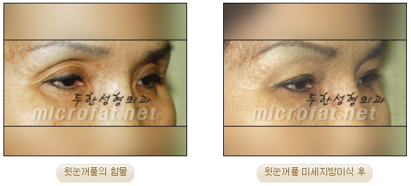 [두한성형외과 미세지방이식] - [자가지방이식] 관련 이미지 10