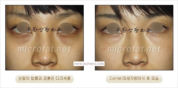 [두한성형외과 경쟁력 눈밑성형] - [눈밑 미세지방이식으로 다크써클 치료] 관련 이미지 19