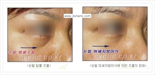 [두한성형외과 경쟁력 눈밑성형] - [다크써클 수술 안내 2.] 관련 이미지 5