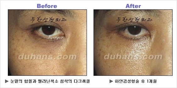 [두한성형외과 경쟁력 동안성형 리더] - ​[미간주름, 이마주름, 안검성형, 이마거상술, 눈썹거상술] 관련 이미지 106