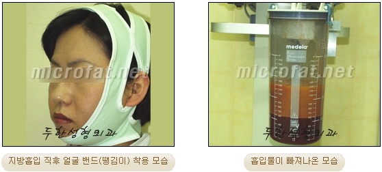 얼굴지방이식 두한성형외과 - 볼지방이식 관련 이미지 49