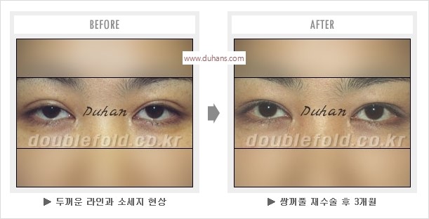 [두한성형외과 경쟁력 눈성형] - [나에게 맞는 어울리는 쌍꺼풀 라인] 관련 이미지 19