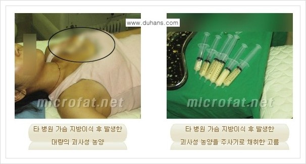 ​[두한성형외과 경쟁력 미세지방이식] - [타병원에서의 미세지방이식 부작용 종류와 문제점 안내] 관련 이미지 11