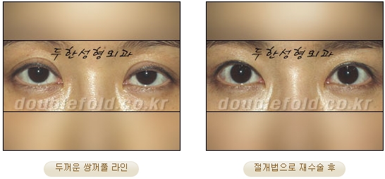 [Duhan Plastic Surgery Double Eyelid Revision Surgery] - [Ptosis Correction Surgery] image 40
