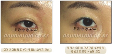 [두한성형외과 쌍커플 재수술] - [비절개눈매교정 재수술] 관련 이미지 18
