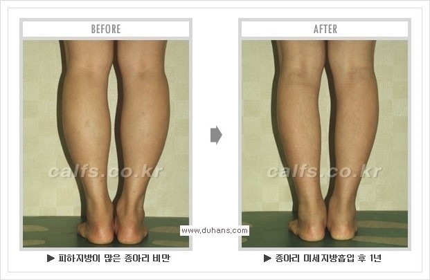 [두한성형외과 경쟁력 멀티종아리성형] - [종아리성형 방법별 전후 주의사항] 관련 이미지 24