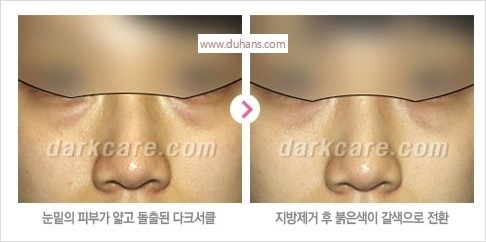 [두한성형외과 경쟁력 눈밑성형] - [다크써클 치료 실패의 원인 분석] 관련 이미지 5