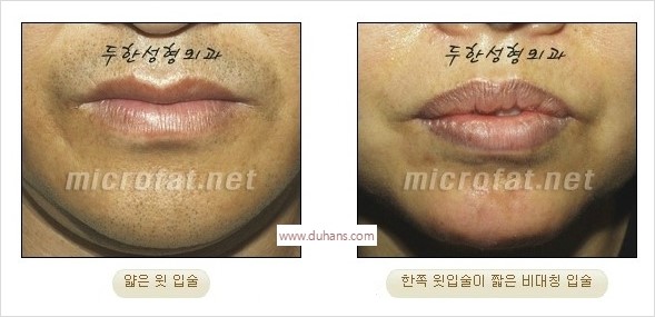 ​​​[두한성형외과 경쟁력 지방이식] - [지방이식을 이용한 입술성형 안내] 관련 이미지 2