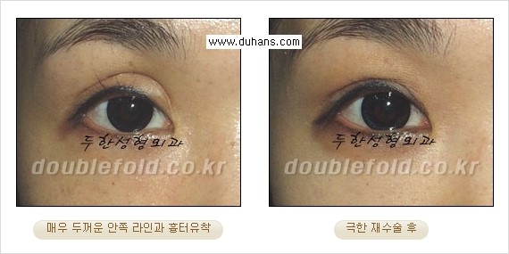 [두한성형외과 경쟁력 쌍꺼풀 재수술, 극한 눈재수술] - [망가진 쌍꺼풀 라인을 교정하는 극한 재수술을  위한 계획] 관련 이미지 10