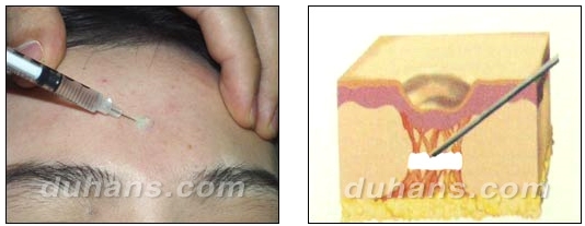 [DuHan Plastic Surgery Scar] - [DHL Simple Scar Treatment] image 3