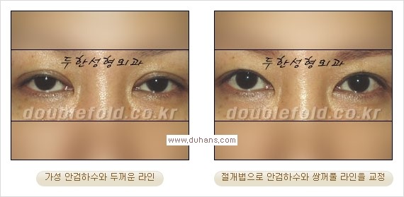 [두한성형외과 경쟁력 눈성형] - [안검하수(졸린눈매) 눈매교정 여러 가지 방법 안내] 관련 이미지 15