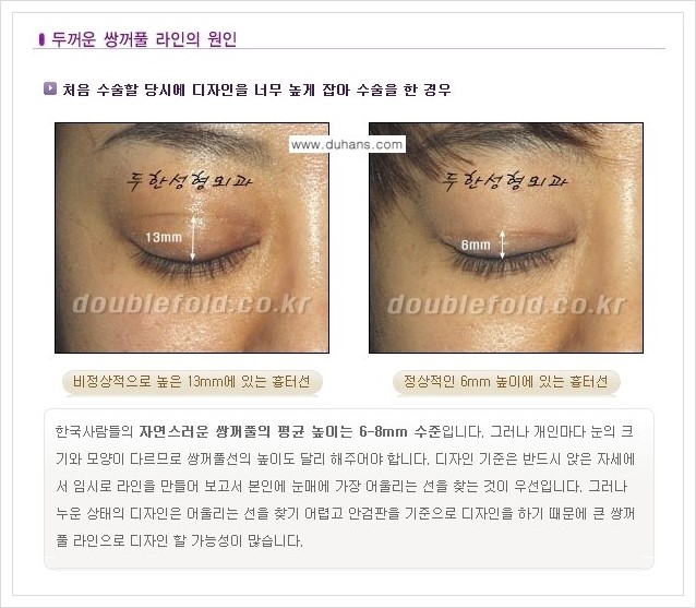 [두한성형외과 경쟁력 쌍꺼풀 재수술] - [두껍고 어색한 라인 교정하는 방법 안내 1.] 관련 이미지 2
