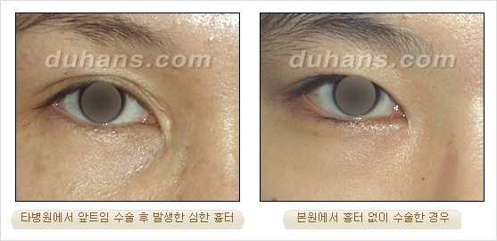 [DuHan Plastic Surgery Eye Surgery] - [Guide to Epicanthoplasty and Canthoplasty for Increasing the Horizontal Width of the Eyes] image 11