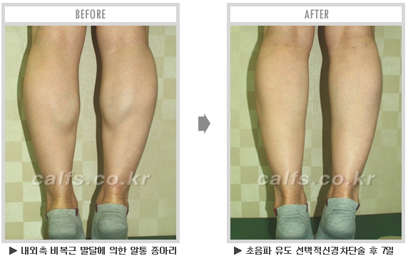 [종아리성형 두한성형외과] - [종아리수술에 대한 자주하는 질문과 답변 모음] 관련 이미지 55