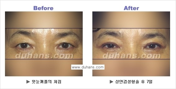 [두한성형외과 NO.1 눈성형] - [상안검 수술에 대한 정보] 관련 이미지 3
