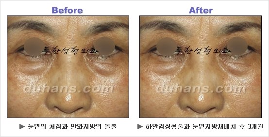 [두한성형외과 경쟁력 동안성형 리더] - ​[미간주름, 이마주름, 안검성형, 이마거상술, 눈썹거상술] 관련 이미지 82