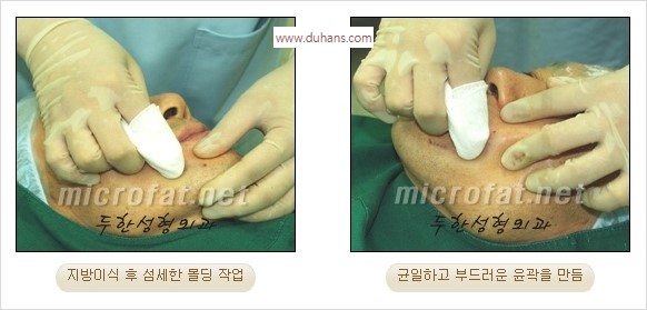 [두한성형외과 경쟁력 안면윤곽 교정] - [자연스럽고 균형있는 턱으로의 복원 미세지방이식과 간편 사각턱 보톡스 안내] 관련 이미지 36