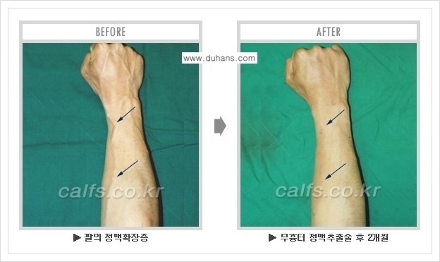 ⁠⁠[두한성형외과 정맥류 치료] - [손, 팔 정맥확장증 사진자료 안내 ②] 관련 이미지 8