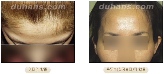 [두한성형외과 얼굴자가지방이식] - [볼살, 이마, 측두부] 관련 이미지 2