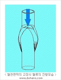 [두한성형외과 경쟁력 정맥류 치료] - [정맥류의 원인과 문제점, 정맥류 진단 방법] 관련 이미지 3