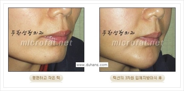 ⁠⁠[두한성형외과 경쟁력 미세지방이식] - [턱 미세지방이식 - 안면윤곽 교정 안내] 관련 이미지 13