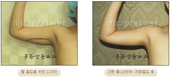 두한성형외과 지방흡입 - 부위별 안전 지방흡입 관련 이미지 22