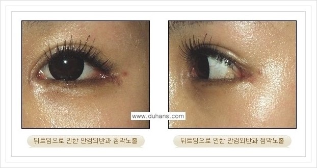 [두한성형외과 경쟁력 쌍꺼풀 재수술, 극한 눈재수술] - [뒤트임 부작용과 뒤트임 교정수술 방법 안내] 관련 이미지 6