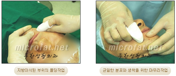 Fat Grafting Leader Duhan Plastic Surgery - Everything About Fat Grafting image 63