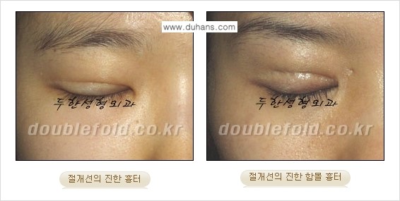 [두한성형외과 함께하는 아름다운 눈매로의 변신] - [흉터선이 진한 경우] 관련 이미지 2
