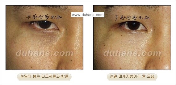 [두한성형외과 경쟁력 미세지방이식] - [다크써클 & 눈밑주름 미세지방이식 5.] 관련 이미지 5