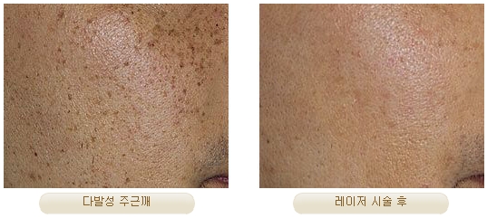 Duhan Plastic Surgery Laser Treatment - Mole Removal, Spot Removal, Melasma, Blemishes, Hyperpigmentation, Skin Tone Improvement, Elasticity Improvement, Skin Texture Improvement image 33