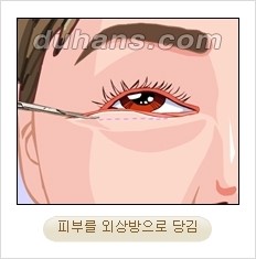 [두한성형외과 경쟁력 동안성형 리더] - ​[미간주름, 이마주름, 안검성형, 이마거상술, 눈썹거상술] 관련 이미지 62