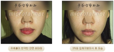 [두한성형외과 얼굴지방이식] - [볼지방이식] 관련 이미지 29