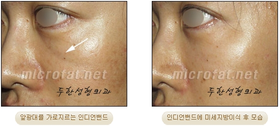 [Duhan Plastic Surgery Face Autologous Fat Grafting] - [Noble Surgery and Indian Band Fat Grafting] image 26