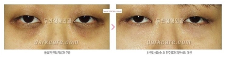 [두한성형외과 경쟁력 눈밑성형] - [다크써클의 모든 것] 관련 이미지 32