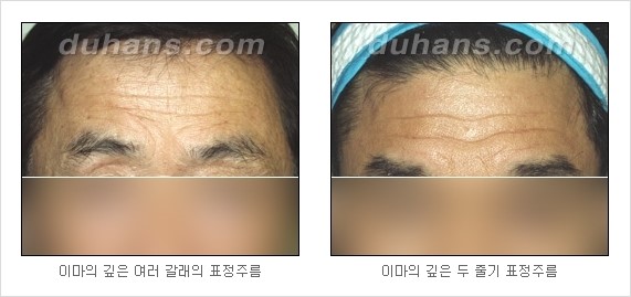 [두한성형외과 경쟁력 주름성형] - [자가 미세지방이식을 이용한 주름 교정] 관련 이미지 8
