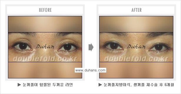 [두한성형외과 NO.1 쌍꺼풀 재수술, 극한 재수술] - [안검하수 교정이 불가능할 경우의 문제점 해결 안내] 관련 이미지 4