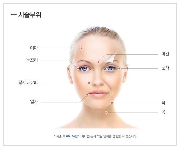 [두한성형외과 경쟁력 주름성형] - [HIFU 초음파 리프팅 주름교정술 안내 2.] 관련 이미지 4