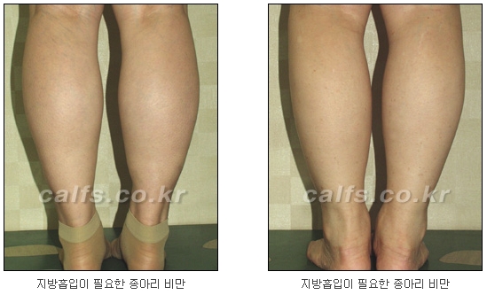두한성형외과 지방흡입 - 부위별 안전 지방흡입 관련 이미지 27