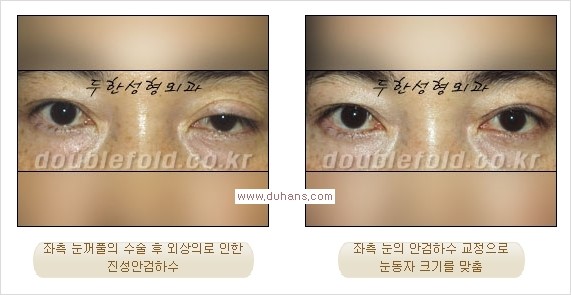 [두한성형외과 경쟁력 눈성형] - [안검하수(졸린눈매) 눈매교정 여러 가지 방법 안내] 관련 이미지 5