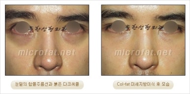두한성형외과 눈밑수술 - 다크서클 수술 전후 관리 안내 관련 이미지 21