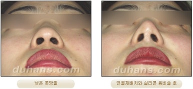 [두한성형외과 코재수술] - [코성형 안내] 관련 이미지 19