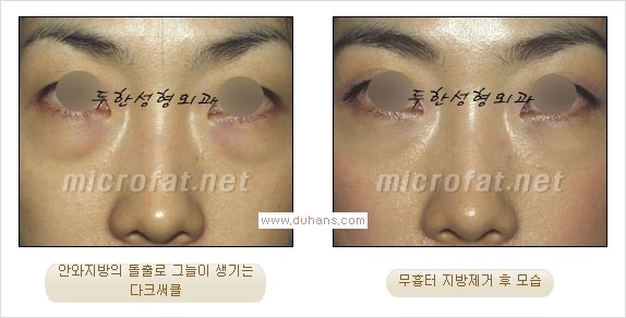 ⁠⁠[두한성형외과 경쟁력 안검성형] - [젊은 눈매를 위한 윗눈꺼풀 지방제거, 눈밑 지방제거] 관련 이미지 26