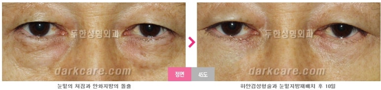 [두한성형외과 다크서클] - [다크서클 전후사진 검증] 관련 이미지 118