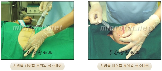 Fat Grafting Leader Duhan Plastic Surgery - Everything About Fat Grafting image 57