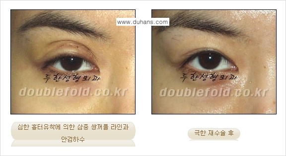 [두한성형외과 NO.1 "극한 눈 재수술"] - [극한 눈 재수술 성공사례 ①] 관련 이미지 6