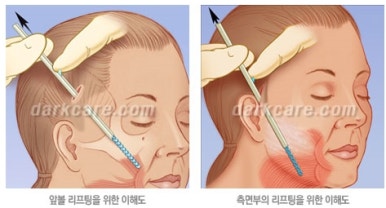 [눈밑수술 두한성형외과] - [다크서클 콤비프로그램] 관련 이미지 127