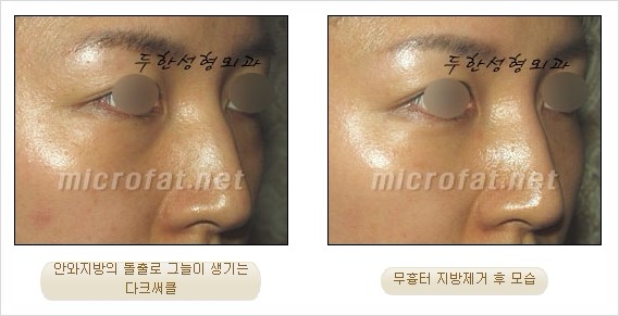 [두한성형외과 쌍커풀수술] - [눈성형 방법에 대한 자주하는 질문과 답변] 관련 이미지 180