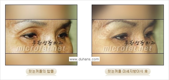 [두한성형외과 경쟁력 미세지방이식] - [두한성형외과 Col-fat(콜펫) 지방이식으로 교정이 가능한 부위 안내] 관련 이미지 5