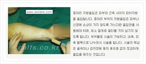 [두한성형외과 경쟁력 멀티종아리성형] - [예쁜 종아리를 만드는 종아리 지방흡입술 안내] 관련 이미지 6